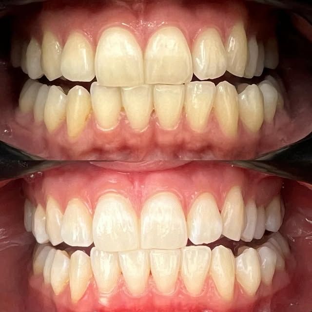 Smile improvement, before and after