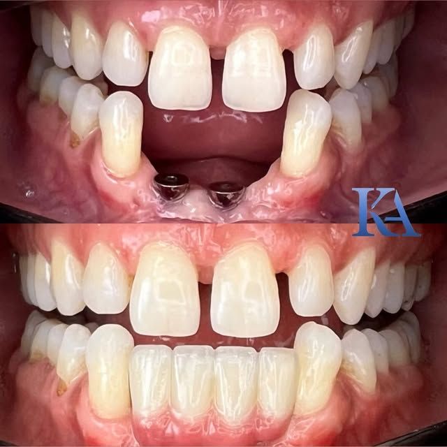 Missing lower teeth replaced with implants, before and after