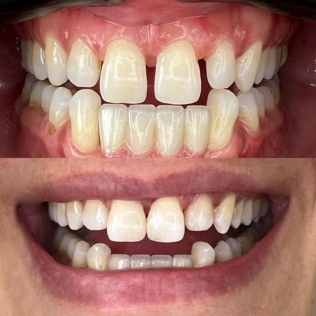 Gap between front teeth closed, before and after
